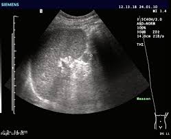 Despite its important role, the spleen is often underestimated. Milz Das Zentralorgan Des Lymphatischen Systems