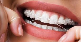 Top left, top right, bottom left, and bottom right. Flossing With Braces How To Floss When You Have Braces The Orthodontists