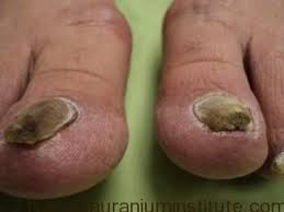 Di peringkat awal kulat kuku jari kaki adalah mungkin untuk merawat keadaan dengan pengilat kuku berubat. Bagaimana Merawat Jangkitan Kulat Kuku