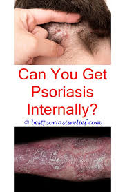 Account Suspended Plaque Psoriasis Treatment Best Treatment For Psoriasis Natural Psoriasis Treatment