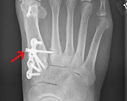 Fremdmaterial Schrauben Platten Ogam Orthopadie