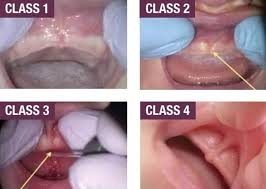 When the baby is crying, and the tongue stays down, it could be caused by a tongue tie actually pulling the tongue down. Lip Tie How To Check Your Baby And How To Fix It