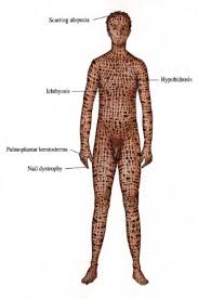 Image result for Ichthyosis