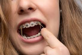Soreness of certain teeth might be because of the elastic working on a proper alignment of upper and lower jaws. How To Put Rubber Bands On Braces Premier Orthodontics