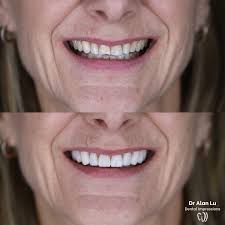 Smile Makeover by Dr Alan Lu at Dental Impressions! Contact us to make a  booking: 011 465 9747 067 310 9667 info@dentalimpressions.co.za #dental  #cosmeticdentistry #veneers #smilemakeover #teeth #crowns #healthcare