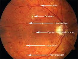 Fundus Image Of Diabetic Retinopathy Diabetic Retinopathy Eye Facts Eye Health