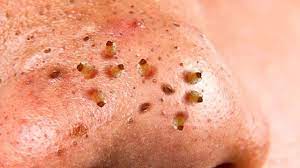 Emuaid.com has been visited by 100k+ users in the past month Bellaseasons Effective Ways To Remove Blackheads