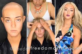 Model with Alopecia shares powerful video of herself without a wig to  encourage people to 'accept their imperfections' |