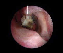 Vond lukt i oppvaskmaskinen trenger ikke bety dyre reparasjonskostnader. Osteomyelitt Etter Radiobolgekonkotomi Tidsskrift For Den Norske Legeforening