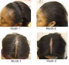 Black castor oil is obtained after roasting the castor beans. Regeneration Potenter Jamaikanisches Schwarzes Rizinusol Fur Traktion Alopezie 4oz Ebay