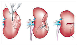 kidney cyst causes symptoms diagnosis and treatment