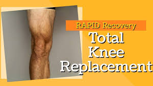 2 Key Exercises To Rapid Recovery For Total Knee Replacement Youtube Knee Replacement Total Knee Replacement Knee Replacement Recovery
