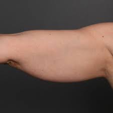 You may begin to see results in as little as three weeks after your initial treatment. Coolsculpting Salt Lake City Ut Results Angela Keen M D Angela Keen Md