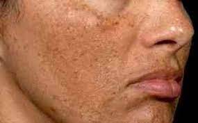 Remedio para quitar manchas en la aclarar la piel o blanqueamiento es una condición explotada por el método de la tez de la luz visible. Como Eliminar Las Manchas Del Sol En La Cara Conoce Dos Recetas Caseras Que Te Ayudaran A Quitarte Las Quitar Manchas Cara Manchas Del Sol Manchas En La Cara