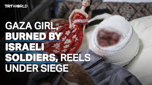 Gaza girl, burned by an Israeli ...
