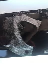A scan in the early weeks is usually your to date your pregnancy. Dating Scan Today Measuring 2 Weeks Behind March 2020 Babies Forums What To Expect