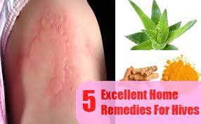 5 Excellent Home Remedies For Hives Home Remedies For Hives Hives Remedies Natural Remedies For Allergies