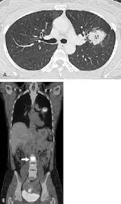 Lung cancer symptoms in women: A 41 Year Old Woman With Non Small Cell Lung Cancer Presenting With Download Scientific Diagram