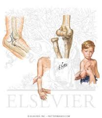 Image result for Radial Head Dislocation