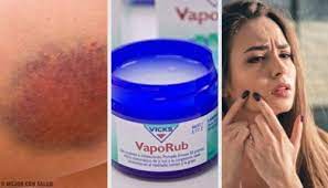 11 Alternative Einsatzmoglichkeiten Fur Wick Vaporub Besser Gesund Leben