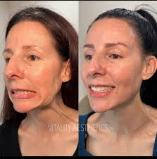 Silk Laser Clinic Bateau Bay (@tina_aestheticnurse) • Instagram photos and  videos