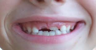 Pin On Smiles Of Bellevue Dental Tips