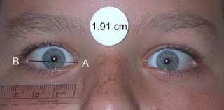 A fold of skin that comes down across the inner angle of the eye. Http Depts Washington Edu Fasdpn Pdfs Facebrain Pdf