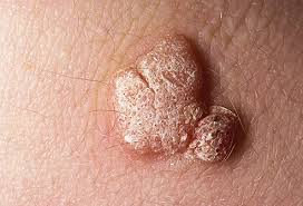 Hpv can spread when your skin or mucosa comes in contact with an infected. Hpv Pictures What Hpv Looks Like
