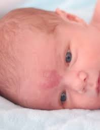 But they're going to take my baby. Mon Bebe A Des Taches Sur La Peau Ou Des Petits Boutons Ca Peut Etre Quoi Pediatre Online