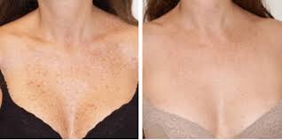 Fresh new skin is revealed underneath and the sunspots get sloughed off with the dead skin. How To Fade Sun Spots And Reverse Sun Damage Blog Huda Beauty