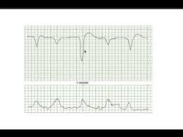 Image result for Early Deceleration