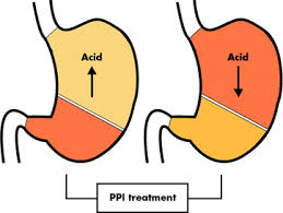 Check spelling or type a new query. What Is A Proton Pump Inhibitor Examples Side Effects Study Com