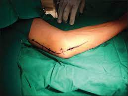 Incision For The Release Of Cubital Tunnel Syndrome Download Scientific Diagram