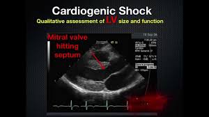 Pocus exam 2 learn with flashcards, games and more — for free. Rush Rapid Ultrasound In Shock Youtube