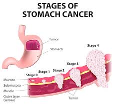 This is the final stage of stomach cancer where the cancerous cells are present in many early stage warnings sign and symptoms of stomach cancer. Stomach Cancer Causes Symptoms Treatment Clicks Health Hub