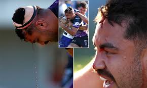 Thank you very much for joining us. Pretty Sure You Can See His Brain Nrl Enforcer Suffers Gruesome Head Injury Daily Mail Online