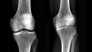 Image result for Knee XRay
