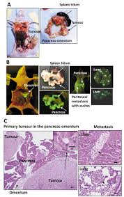 For people in families at high risk of pancreatic cancer, newer tests for detecting pancreatic cancer early may help. Cytology Based Detection Of Circulating Tumour Cells In Human Pancreatic Cancer Xenograft Models With Kras Mutation Anticancer Research