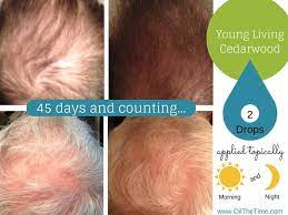 A randomized trial published in the archives of dermatology studied the effects of an eo blend containing cedarwood, rosemary, thyme, and lavender on 86 alopecia areata patients. Pinterest