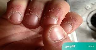 التشققات الجلدية حول الأظافر.. 4 إجراءات منزلية للتخلص منها