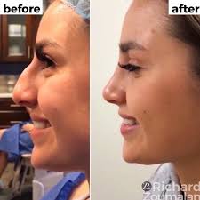 Filler Lipfiller Lips Medicine Nose Nosejobe Filler Lipfiller Lips Nose Nosejobe Nose Plastic Surgery Rhinoplasty Nose Jobs Cosmetic Surgery