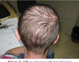 They can be prescribed by a dermatologist specializing in the scalp for cases of androgenetic alopecia and diffuse alopecia in. Diffuse Hair Loss In Secondary Syphilis In Hiv Positive Man Case Report Semantic Scholar