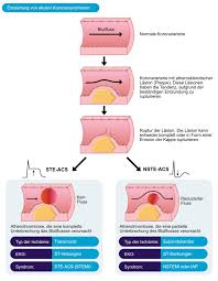 Acute coronary syndromes are medical emergencies that include myocardial infarction (heart attack) and unstable angina (unexpected, severe chest pain). Klassifikation Von Akuten Koronarsyndromen Acs Und Akutem Myokardinfarkt Ami Ekg Echo