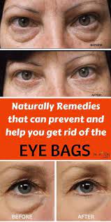 Aloe Vera And Essential Oil To Remove The Stubborn Eye Eye Bags Under Eye Bags Eye Bag Remedies