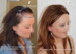 Beiträge / themen letzter beitrag. Haartransplantation Frauen So Funktioniert S Hairforlife