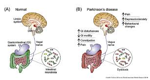 People with parkinson's disease also have tremors and may develop cognitive problems, including memory loss and dementia. New Insights Into The Role Of Gut Microbiota In Parkinson S Disease Gut Microbiota For Health