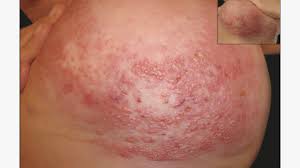 Image result for heat rash under breasts