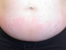 Oral antihistamines can do a great deal to relieve the itching that comes with a rash like puppp. Polymorphic Eruption Of Pregnancy Dermnet Nz