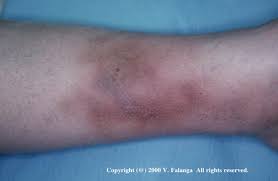 Image result for Lipodermatosclerosis