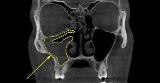 Image result for Maxillary Sinus